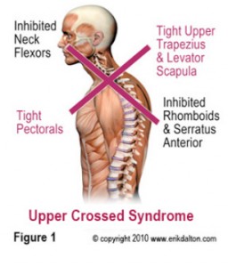 upper-crossed-syndrome